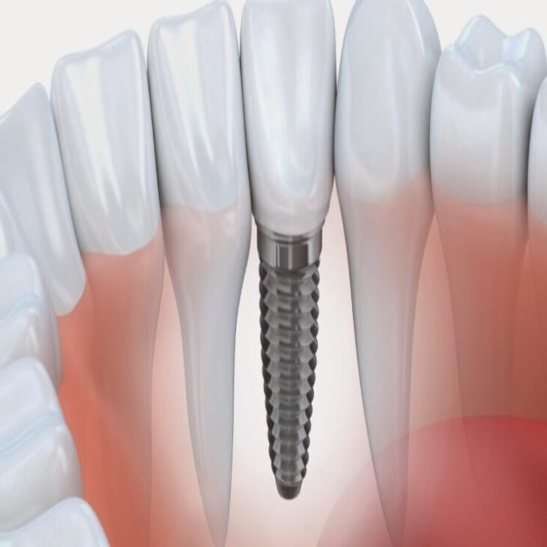 implante-incisivo-inferior-coroa-sobre-vetor-746x413-1-730x405 (1)