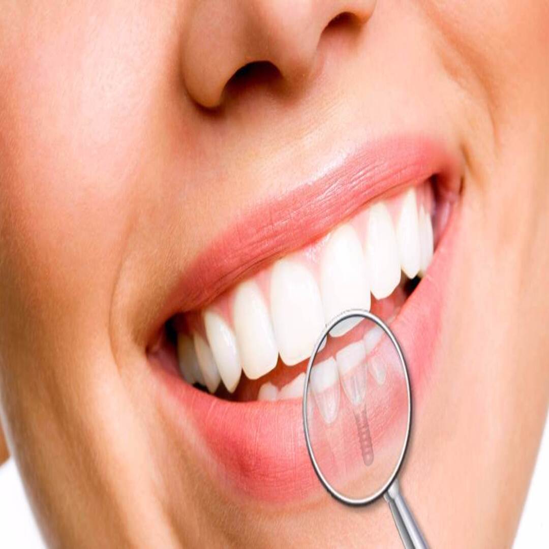 implantes-dentrios-precos